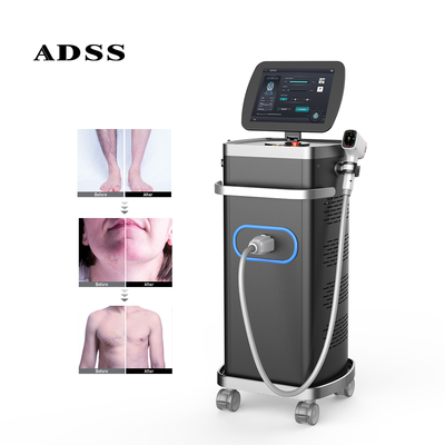 ADSS Hot Sale Laser Diode 4 Wavelengths 808nm Diode Laser Hair Removal Machine for Permanent Hair Removal by Laser