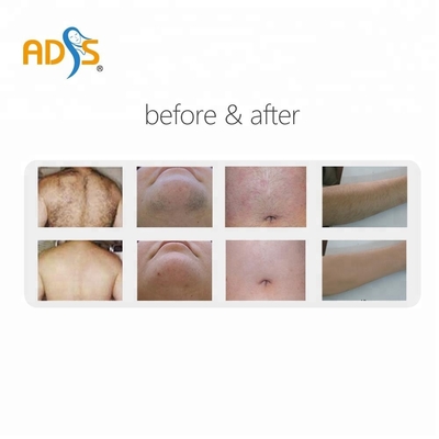 Manufacture ADSS ND YAG  1064nm Long Pulse Laser Hair Removal Laser Device