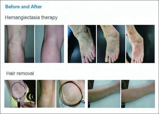 ADSS Laser Long Pulse Nd Yag Laser  Big Spot Size 1064nm Vascular Laser Hair Removal Machine
