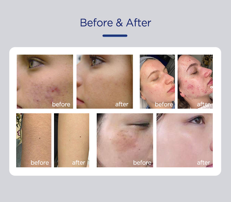 2025 New Big Power Ipl Laser Hair Removal Device and Ipl Hair Removal Machine for Hair Removal Skin Rejuvenation Diodenlaser